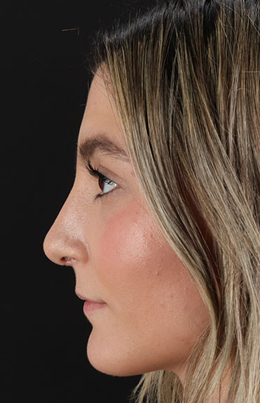 After - left_lateral