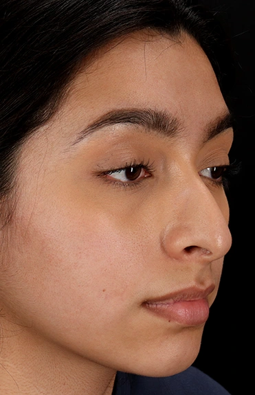 Before - right_oblique