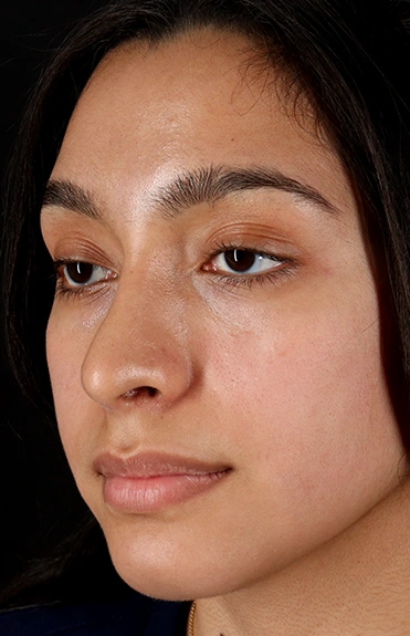 After - left_oblique