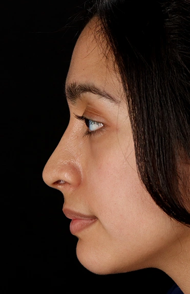 After - left_lateral