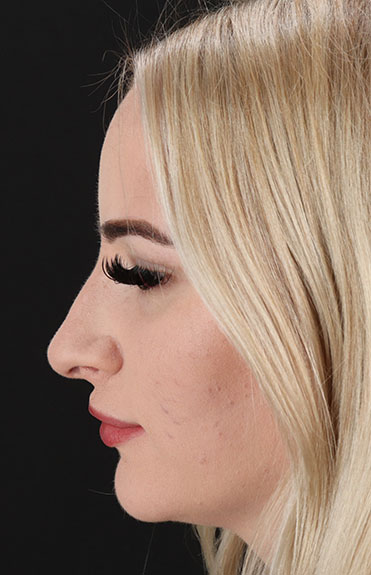 Before - left_lateral