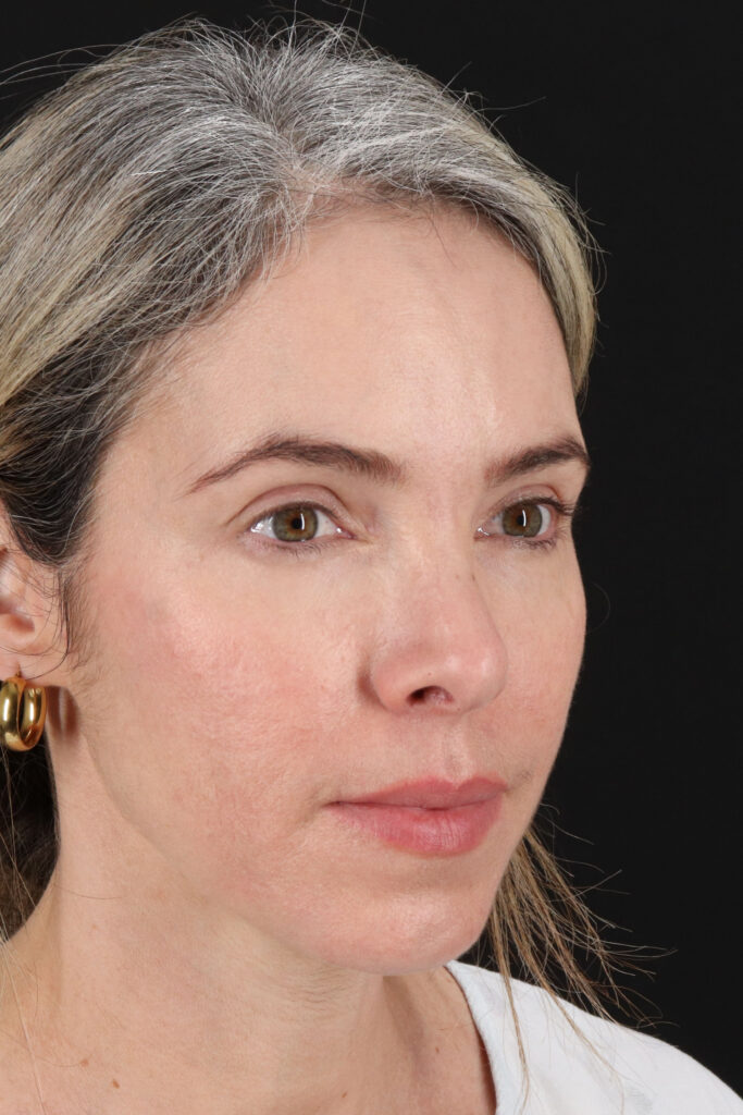 Before - right_oblique