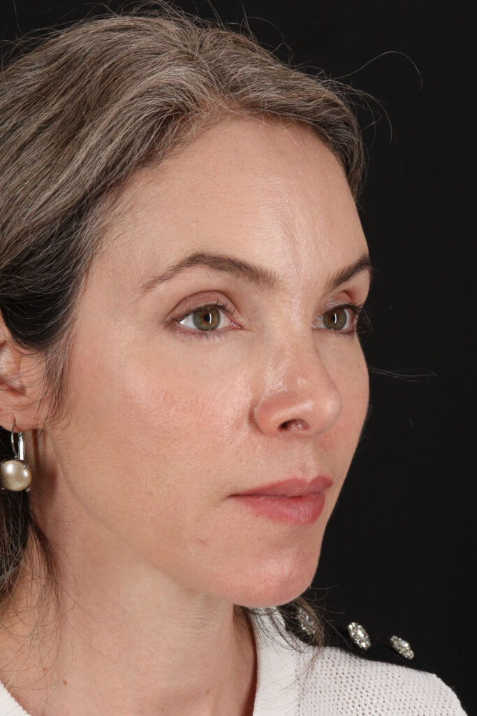 After - right_oblique