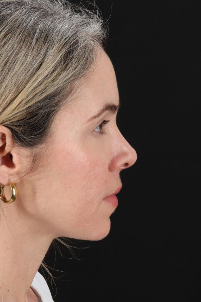 Before - right_lateral