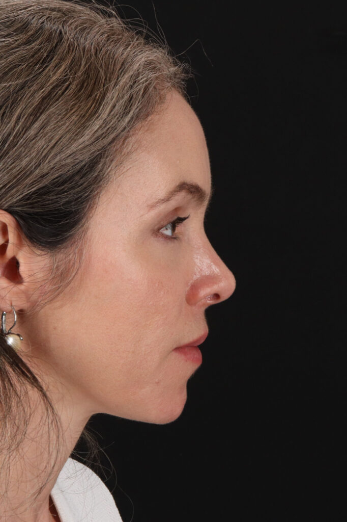 After - right_lateral