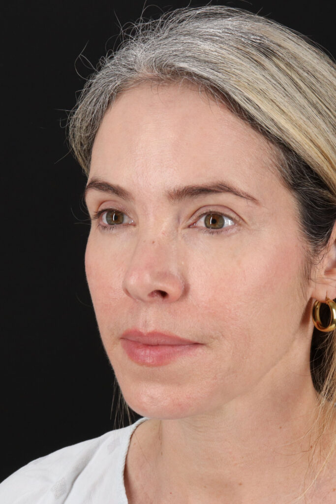 Before - left_oblique