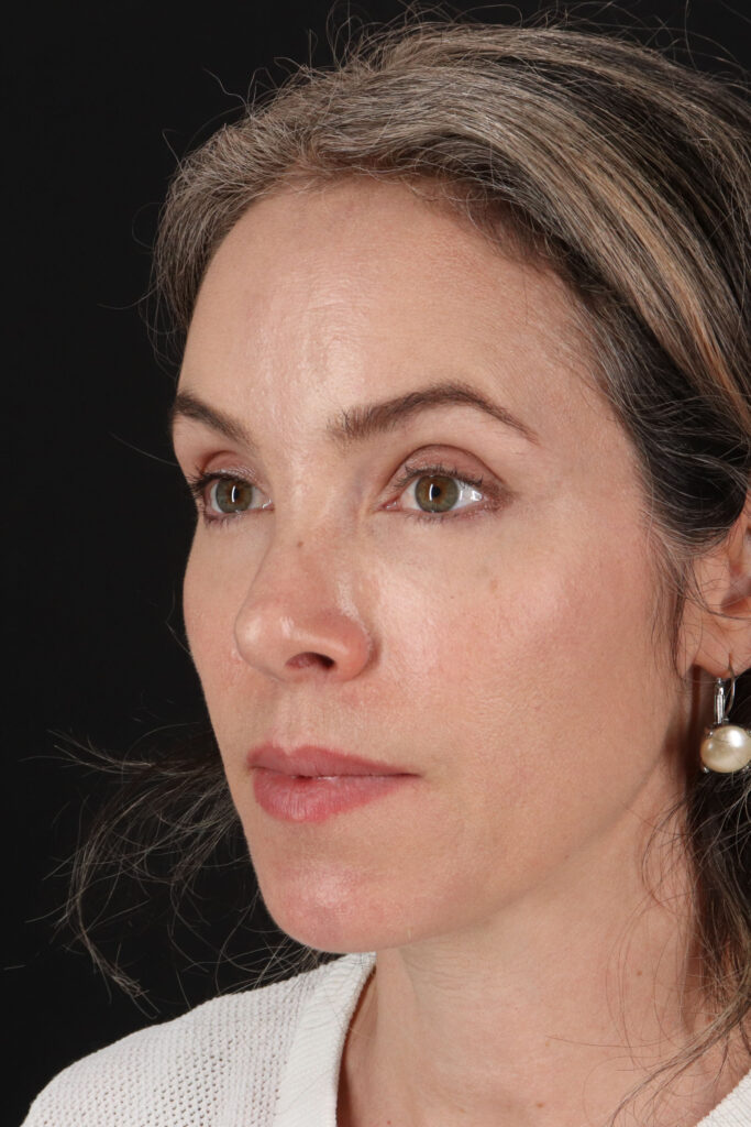 After - left_oblique