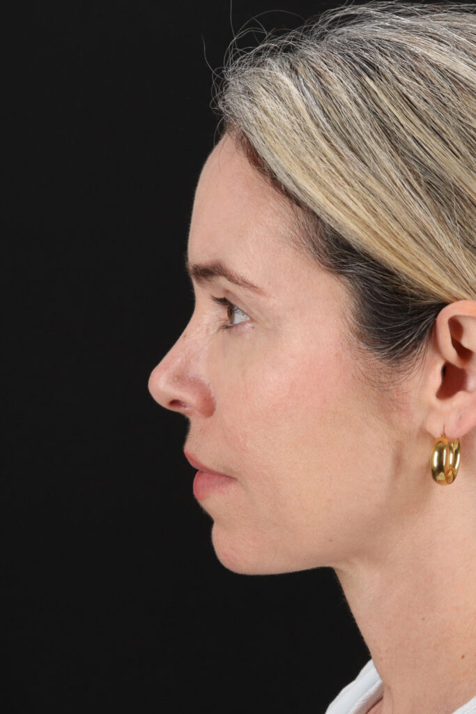 Before - left_lateral