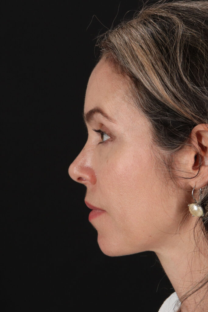 After - left_lateral