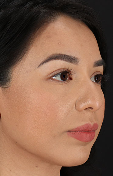 Before - right_oblique