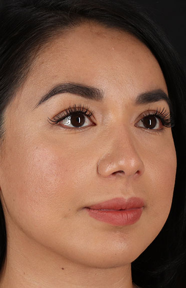 After - right_oblique