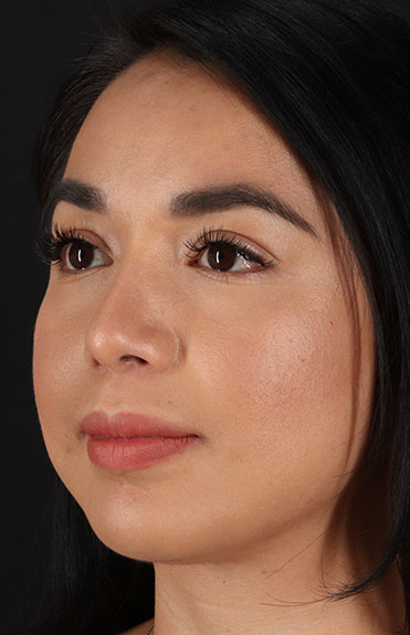 After - left_oblique