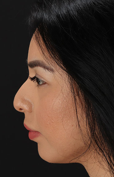 Before - left_lateral