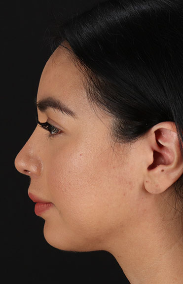 After - left_lateral