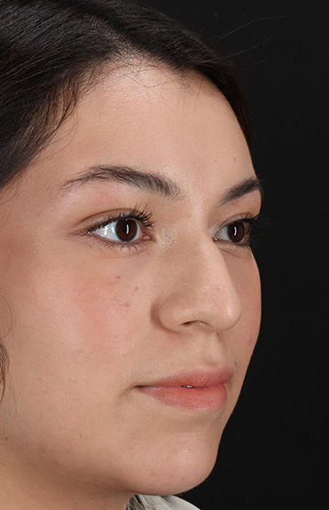 Before - right_oblique