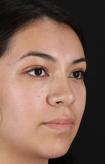 After - right_oblique