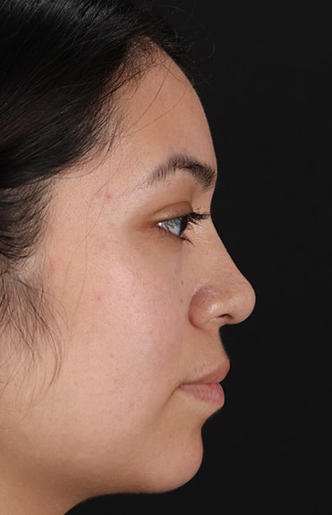 After - right_lateral