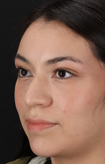 Before - left_oblique