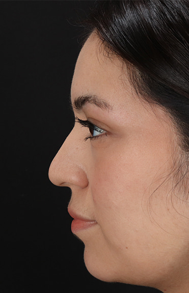 Before - left_lateral