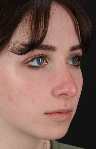 Before - right_oblique