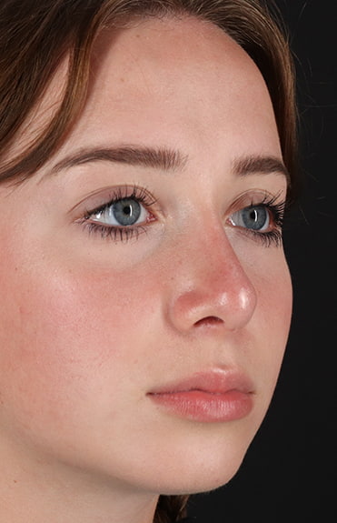 After - right_oblique