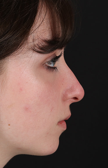 Before - right_lateral