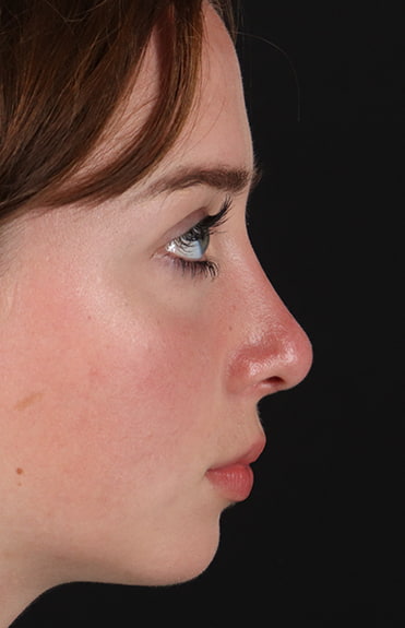 After - right_lateral