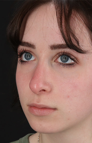 Before - left_oblique