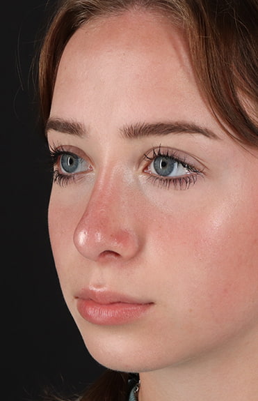 After - left_oblique