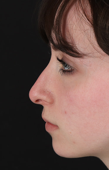 Before - left_lateral