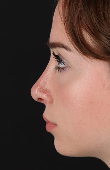 After - left_lateral