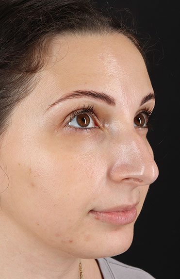 Before - right_oblique