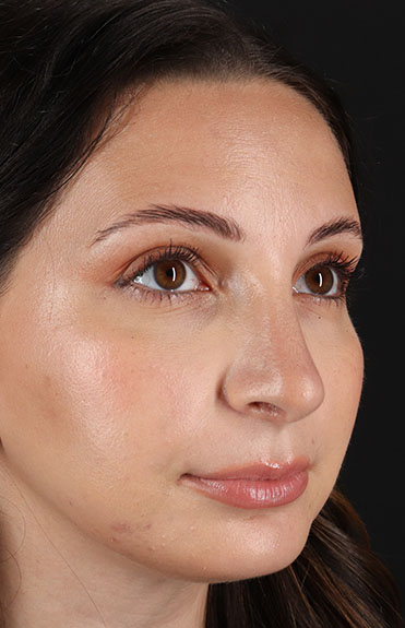 After - right_oblique