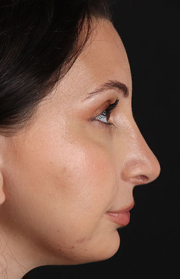 After - right_lateral