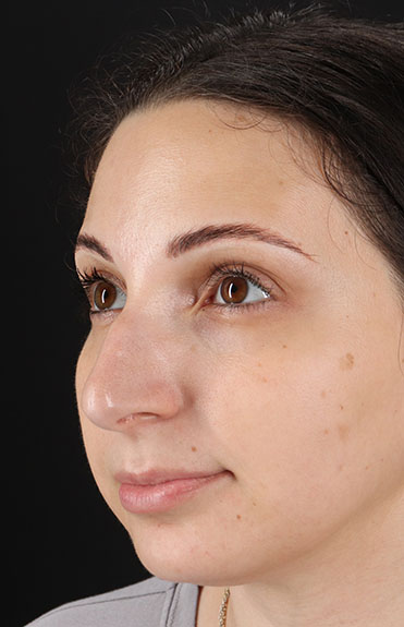 Before - left_oblique