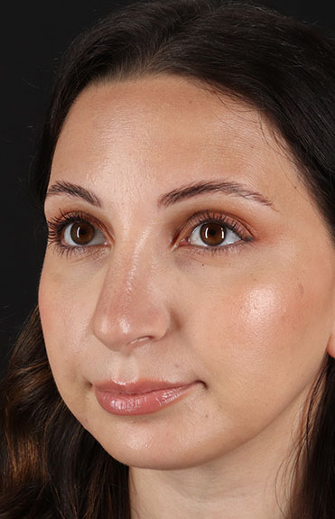 After - left_oblique