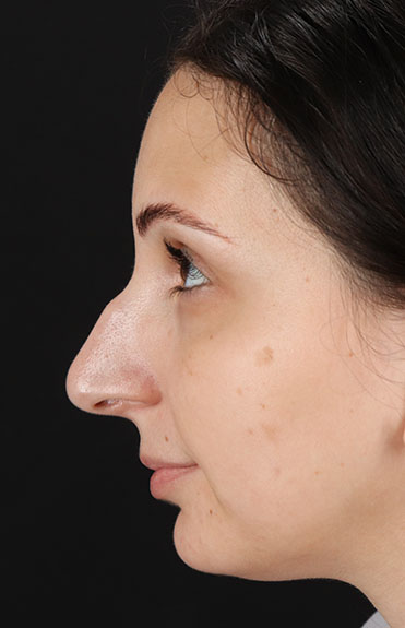 Before - left_lateral