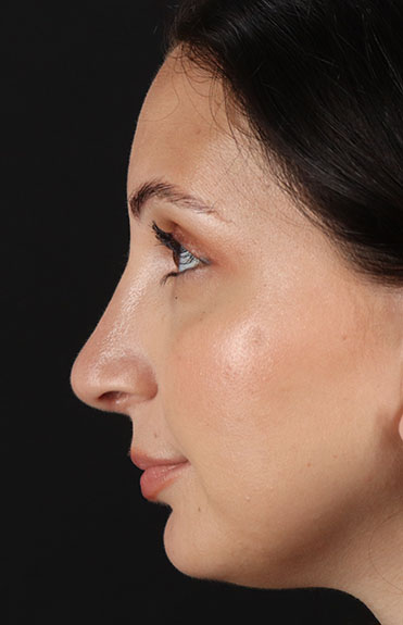 After - left_lateral