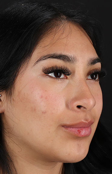 Before - right_oblique