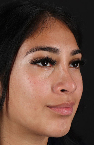 After - right_oblique