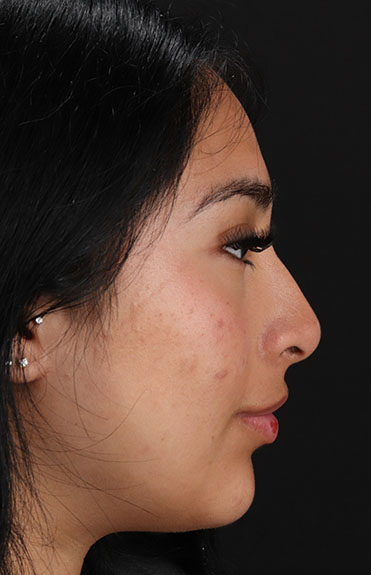 Before - right_lateral