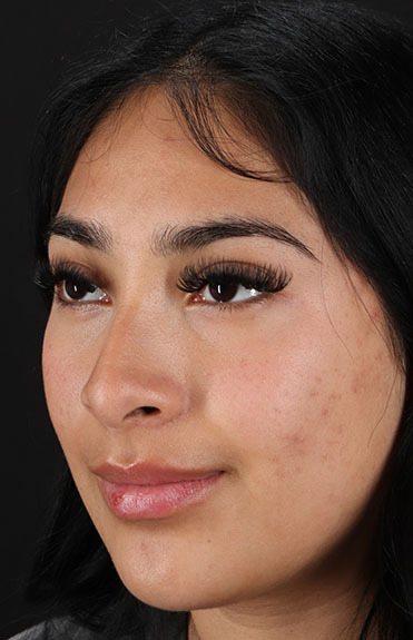 Before - left_oblique