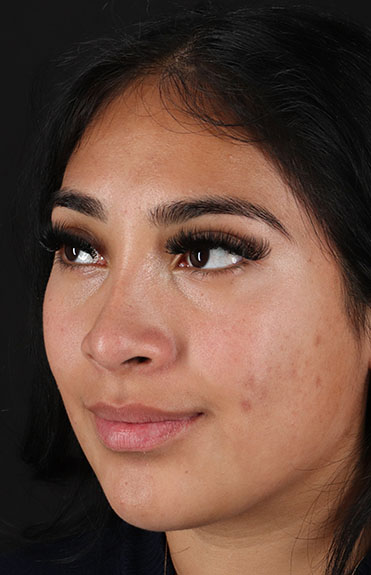 After - left_oblique