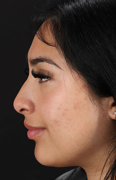 Before - left_lateral