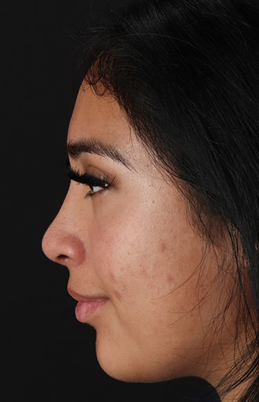 After - left_lateral