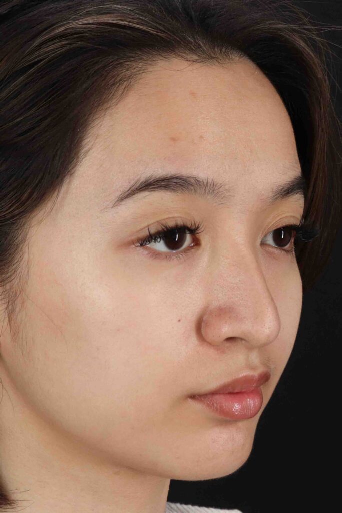 Before - right_oblique