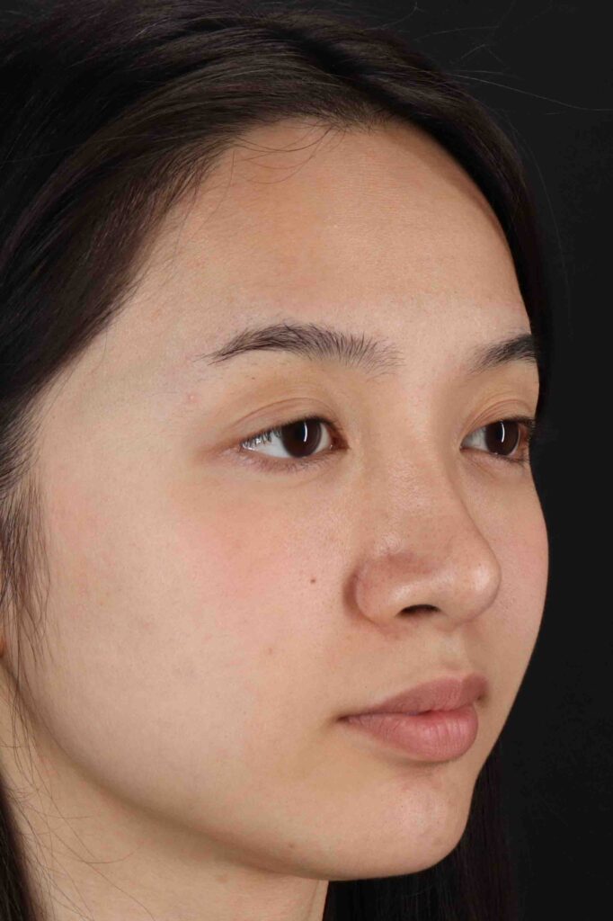 After - right_oblique