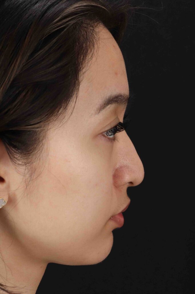 Before - right_lateral