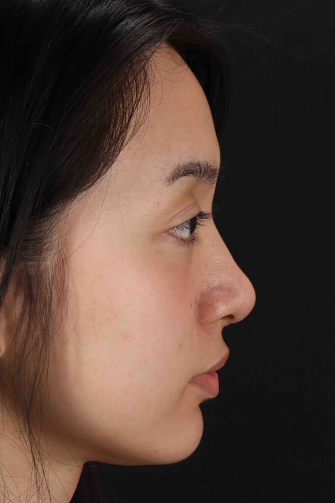 After - right_lateral