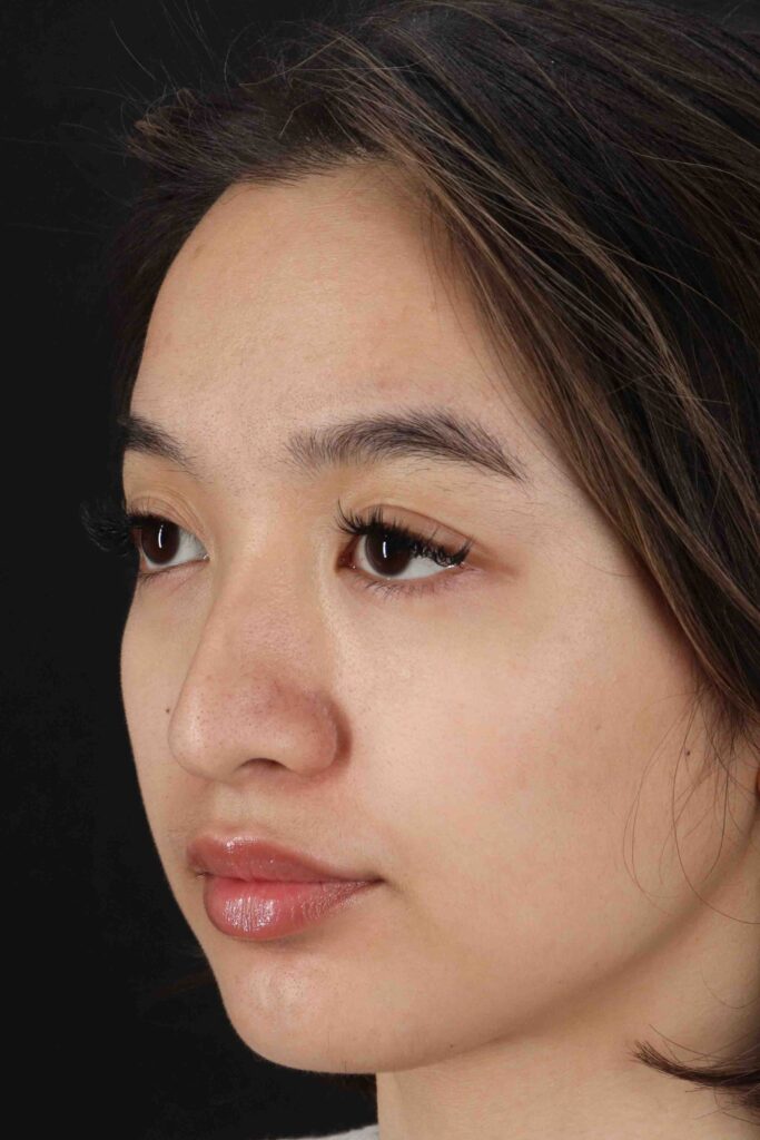 Before - left_oblique